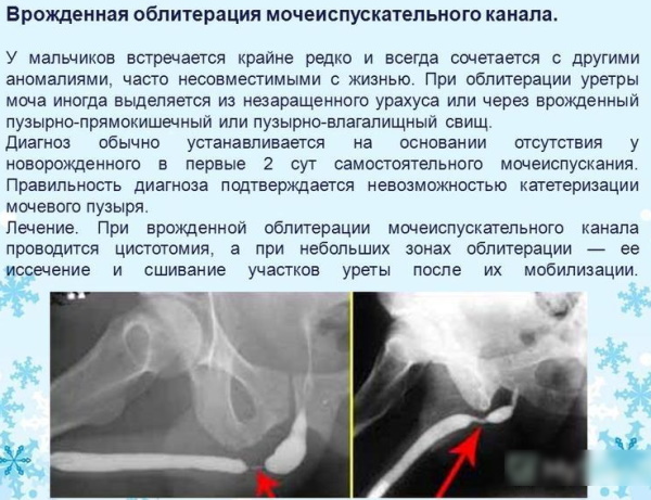 Инфравезикальная обструкция мочевого пузыря