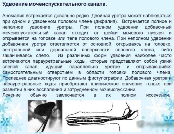 Инфравезикальная обструкция мочевого пузыря