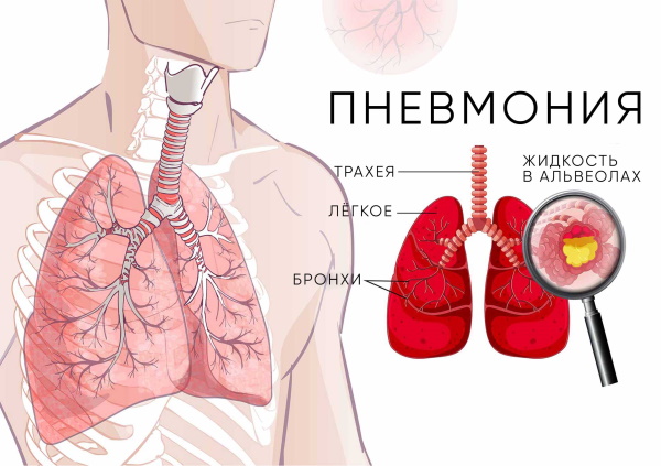 Кальцинаты в легких. Что это у взрослого, опасно ли