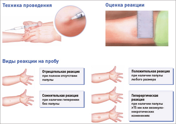 Кальцинаты в легких. Что это у взрослого, опасно ли