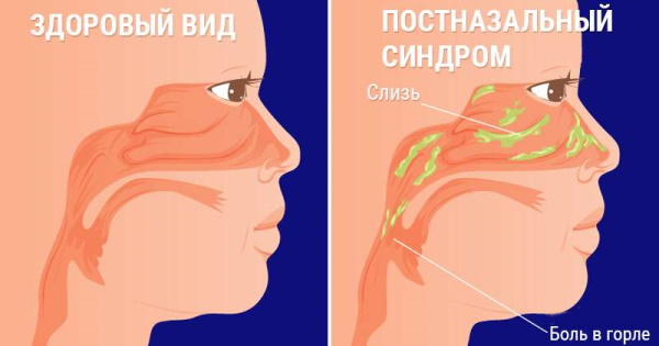 Кашель от соплей у ребенка. Чем лечить при насморке