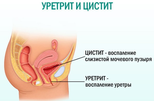 Кандидозный кольпит (вагинит). Лечение у женщин, клинические рекомендации