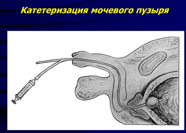 Острая задержка мочи (мочеиспускания). Неотложная помощь, алгоритм