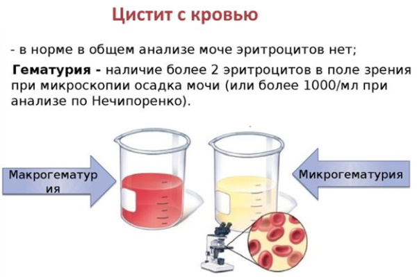 Острый (геморрагический) цистит с кровью у женщин. Лечение