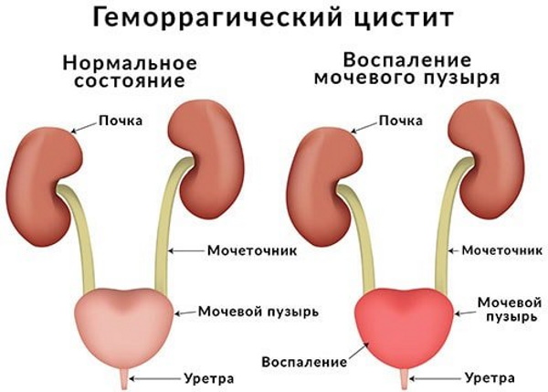 Острый (геморрагический) цистит с кровью у женщин. Лечение