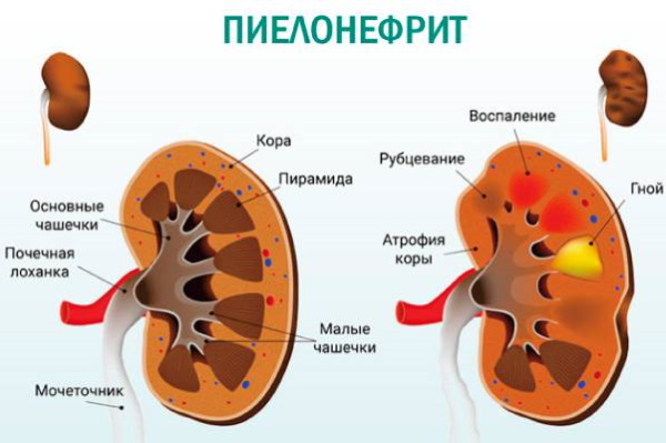 Острый (геморрагический) цистит с кровью у женщин. Лечение