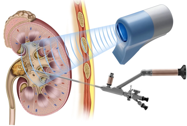 Перкутанная нефролитолапаксия. Что это такое, цена операции