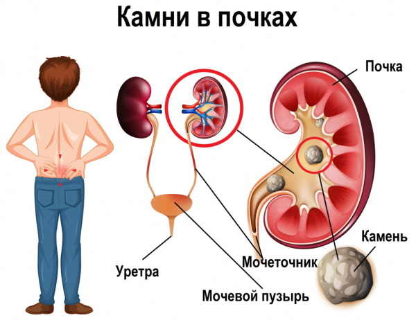 Перкутанная нефролитолапаксия. Что это такое, цена операции