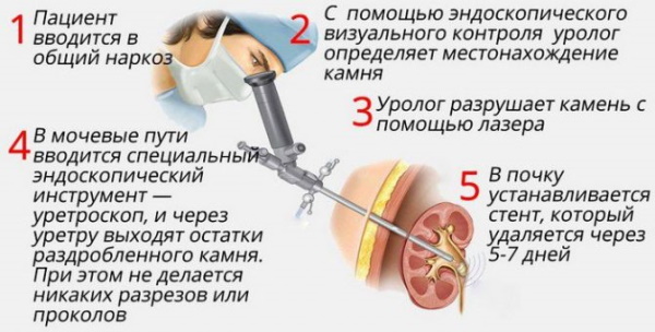 Перкутанная нефролитолапаксия. Что это такое, цена операции