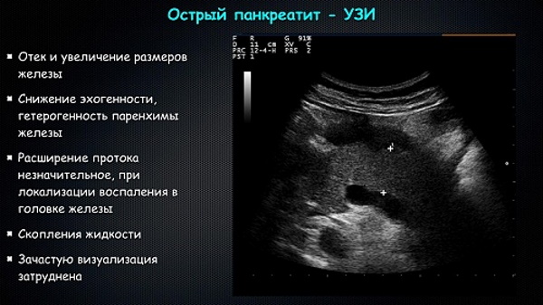 Поджелудочная железа УЗИ. Норма, расшифровка, подготовка