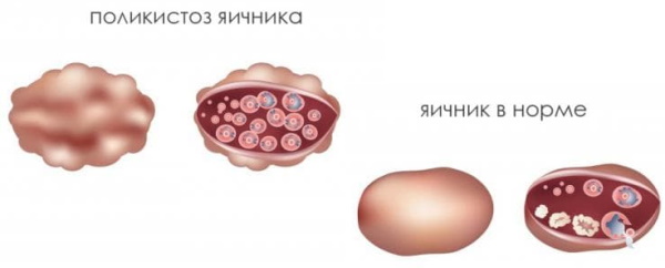 Трансабдоминальное УЗИ органов малого таза. Как это