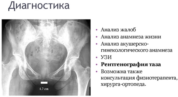 УЗИ лонного сочленения при беременности. Что это, как делают