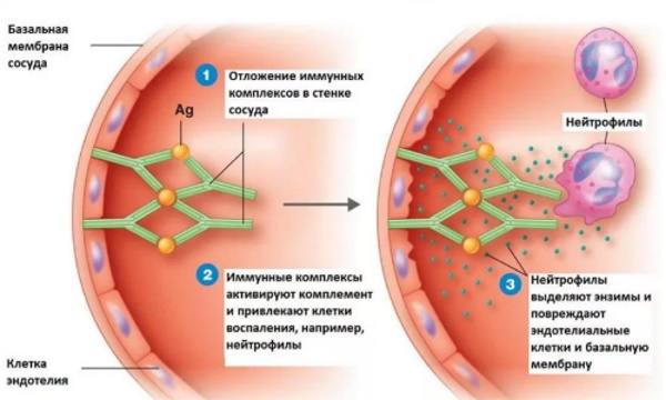 Васкулит. Что это такое, симптомы, лечение, диагностика сосудов