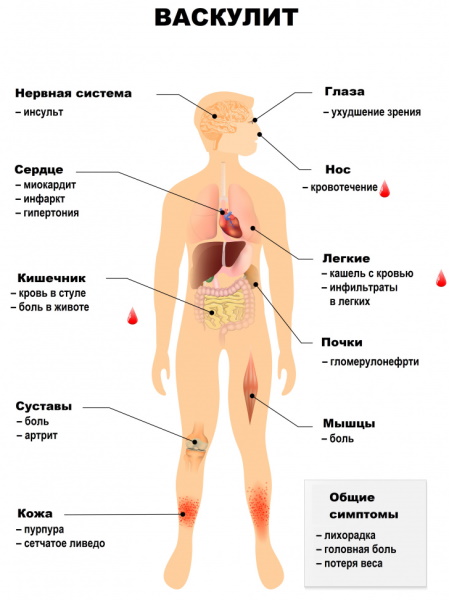 Васкулит. Что это такое, симптомы, лечение, диагностика сосудов