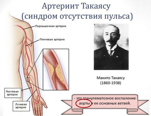 Васкулит. Что это такое, симптомы, лечение, диагностика сосудов