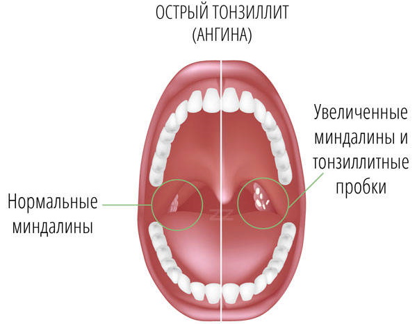 Болит горло только по ночам, а днем не болит