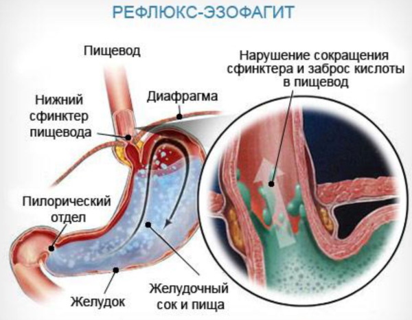 Болит горло только по ночам, а днем не болит