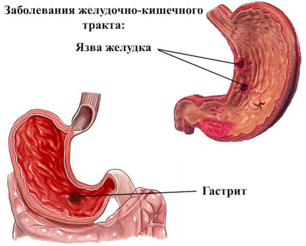 Гепатрин или Эссенциале. Что лучше для печени