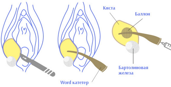 Киста бартолиновой железы. Как лечить, удаление, причины