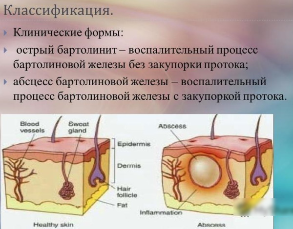 Киста бартолиновой железы. Как лечить, удаление, причины