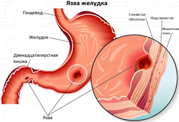 Ксефокам уколы. Аналоги дешевле, цена