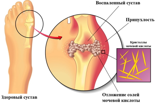 Лазикс или Фуросемид. Что лучше, отличия