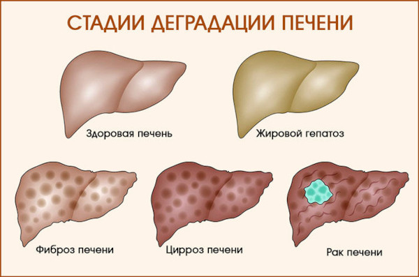 Ледипасвир и Софосбувир. Инструкция по применению, цена