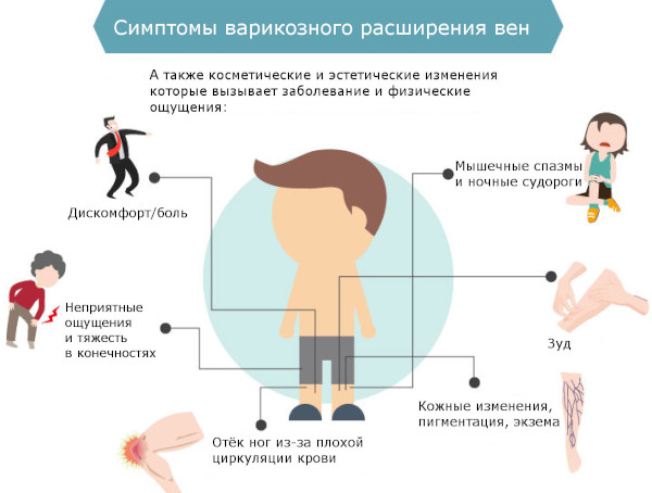 Народные средства от варикоза вен. Лечение