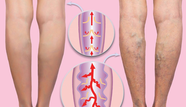 Народные средства от варикоза вен. Лечение