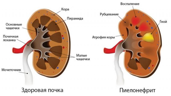 Профилактика цистита у женщин. Лекарства, препараты