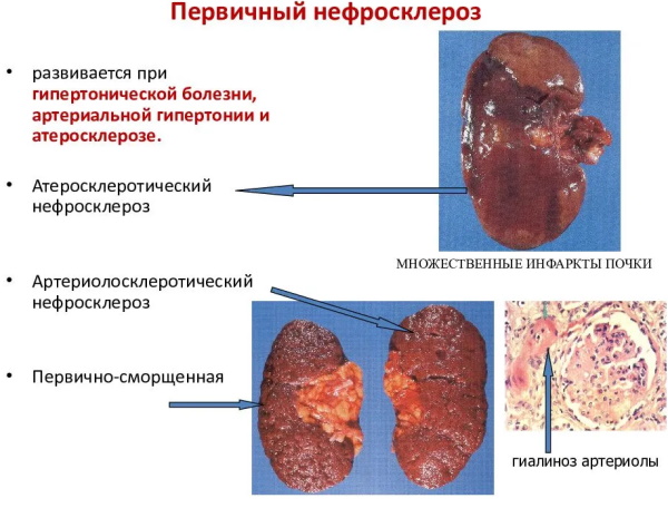 Сморщенная почка на КТ, УЗИ. Что это, симптомы, лечение