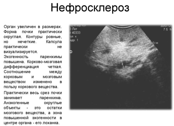 Сморщенная почка на КТ, УЗИ. Что это, симптомы, лечение