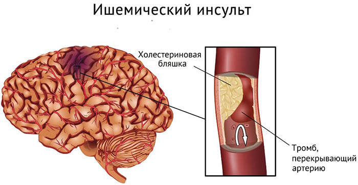 Сосудистые заболевания головного мозга. Симптомы, классификация