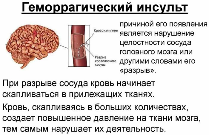 Сосудистые заболевания головного мозга. Симптомы, классификация