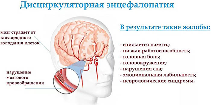 Сосудистые заболевания головного мозга. Симптомы, классификация