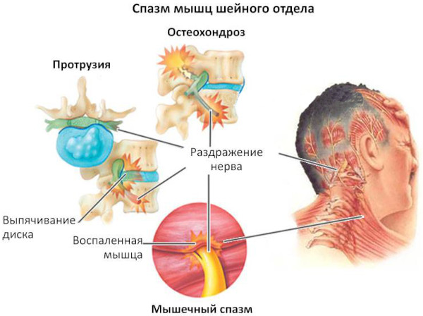 Спазмы мышц шеи. Как снять, симптомы и лечение