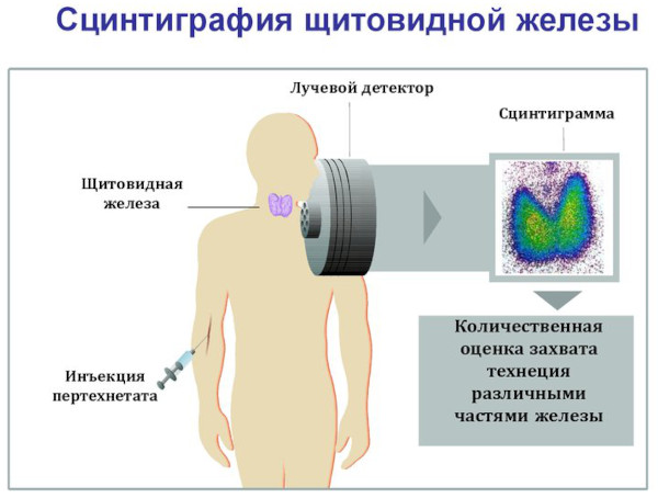 Сцинтиграфия щитовидной железы картинки