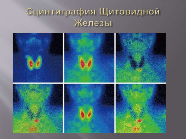 Сцинтиграфия щитовидной железы картинки