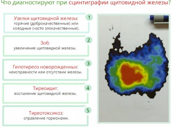 Сцинтиграфия щитовидной железы картинки