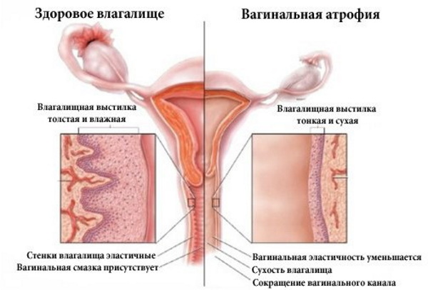 Бактериальный цистит. Лечение у женщин, препараты, симптомы