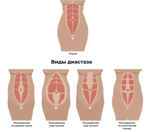Диастаз прямых мышц живота. Фото на УЗИ, лечение, опасность