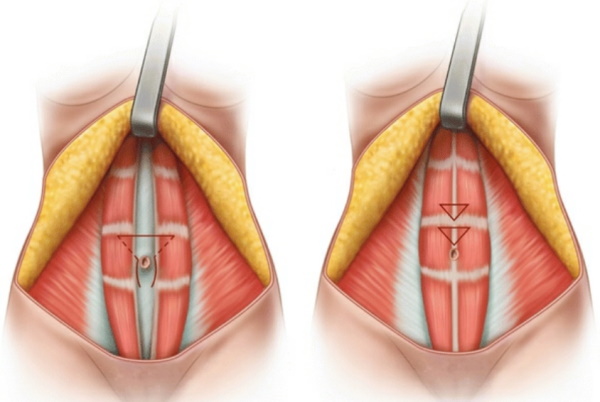 Диастаз прямых мышц живота. Фото на УЗИ, лечение, опасность