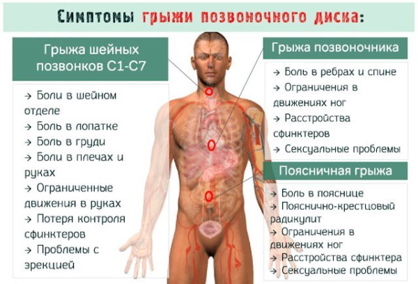 Невропатия (неврит) малоберцового нерва. Симптомы, лечение