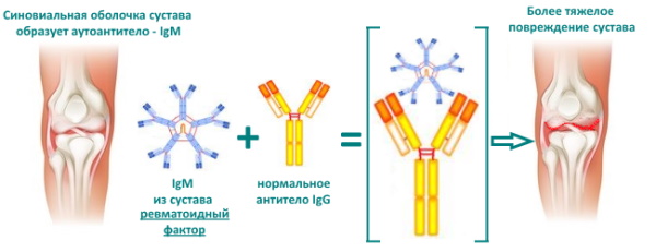 Серопозитивный ревматоидный артрит. Что это такое, лечение, препараты