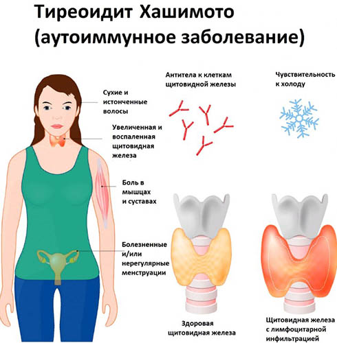 Дисфункция щитовидной железы у женщин. Симптомы, что это