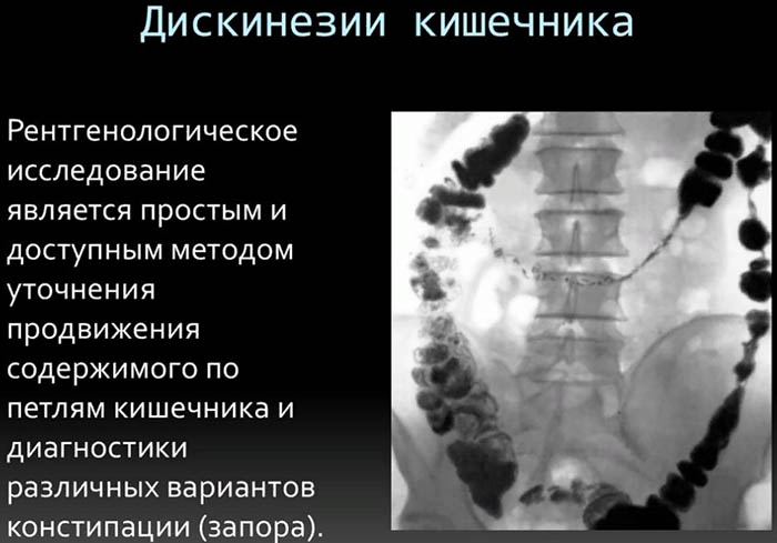 Дискинезия кишечника (толстой кишки). Что это такое у детей, лечение, симптомы