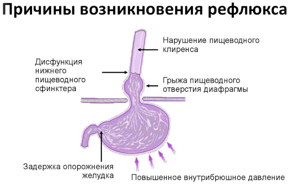 Дистальный рефлюкс-эзофагит катаральный, эрозивный, хронический