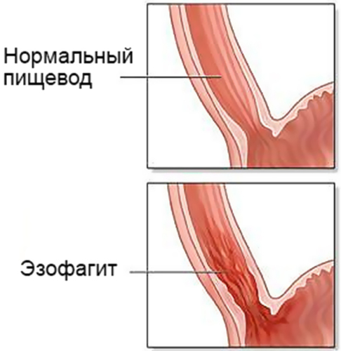 Дистальный рефлюкс-эзофагит катаральный, эрозивный, хронический