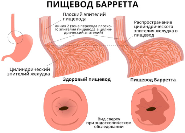 Дистальный рефлюкс-эзофагит катаральный, эрозивный, хронический