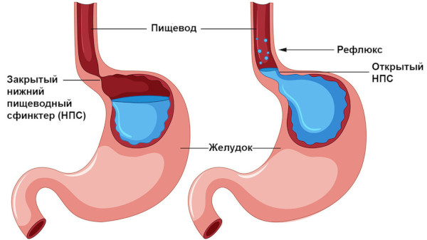 Дистальный рефлюкс-эзофагит катаральный, эрозивный, хронический